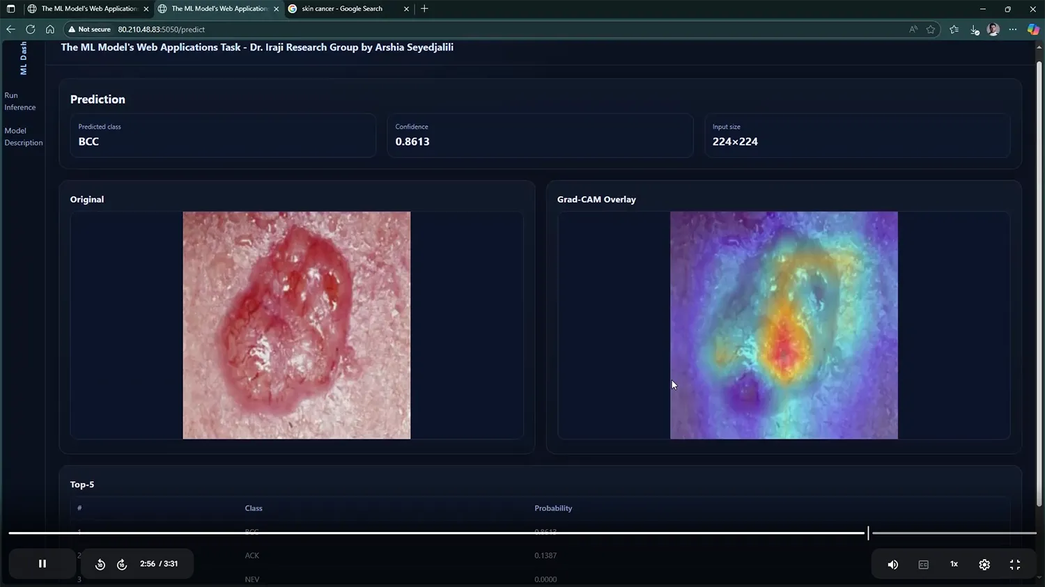 Skin Cancer Prediction